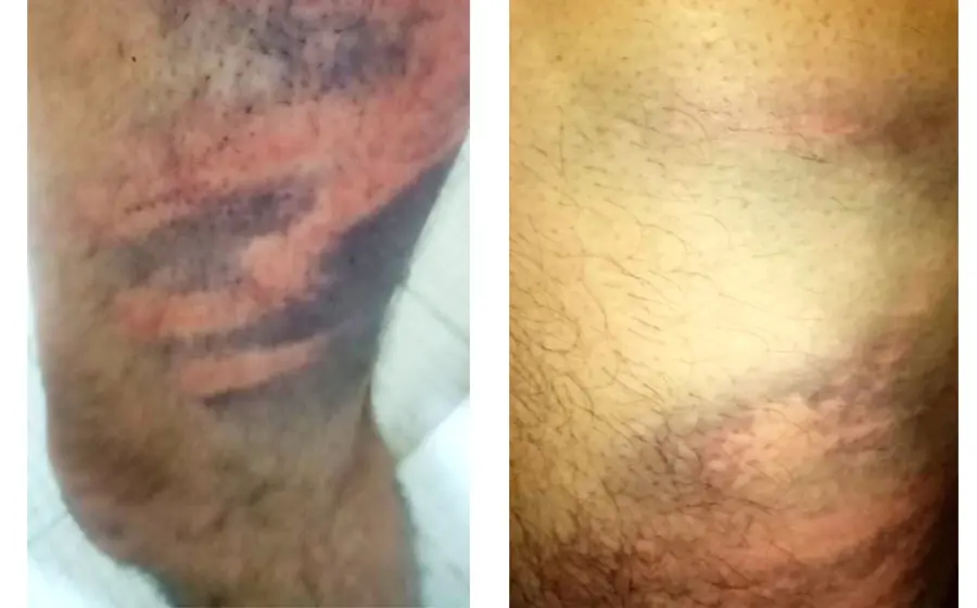 Las lesiones que sufrió Gerson al ser atacado por los elementos de la Policía Municipal de San Jacinto Amilpas.