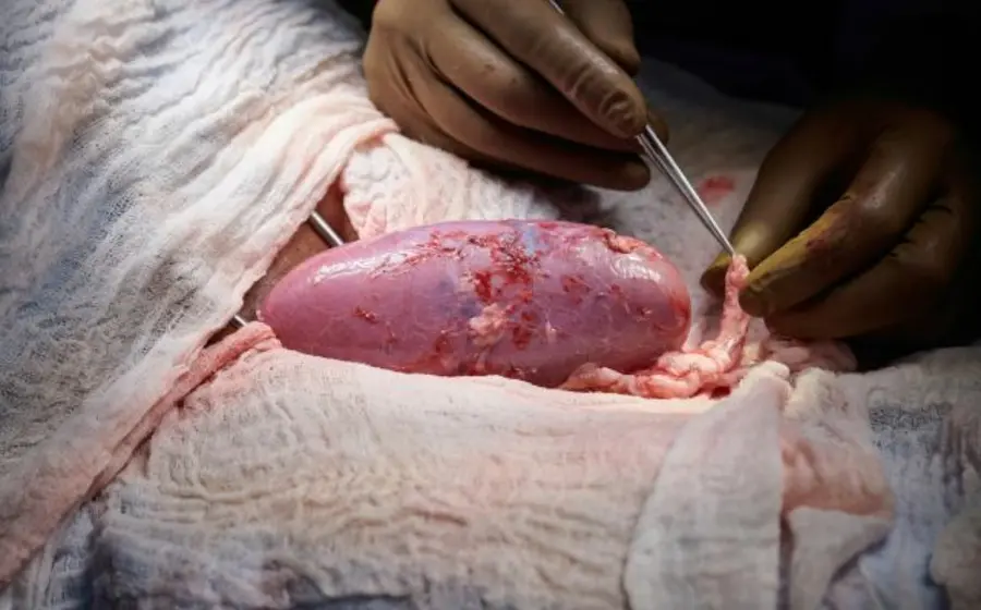 Los cirujanos unieron el riñón del cerdo a un par de grandes vasos sanguíneos fuera del cuerpo de un receptor fallecido para poder observarlo durante dos días.