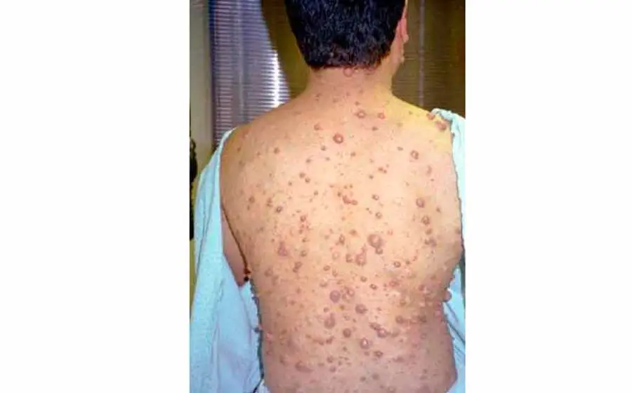 neurofibromatosis