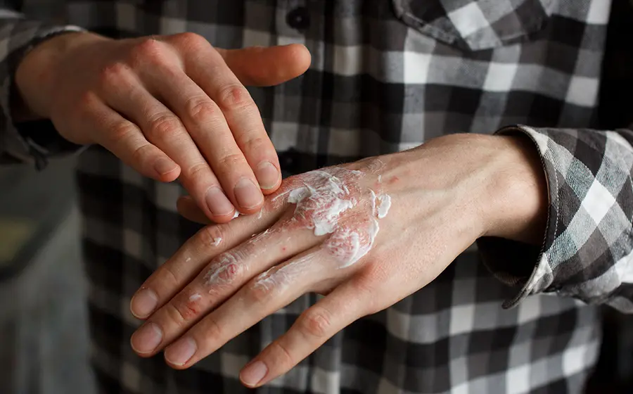 psoriasis