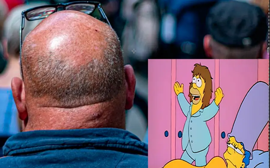 Alopecia