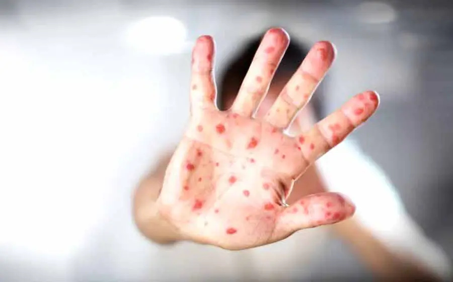 manchas_de_ciruela