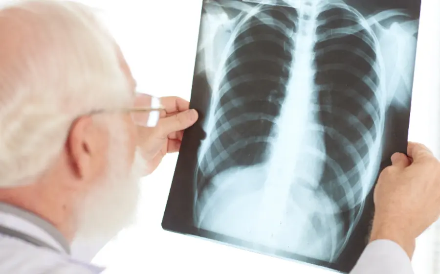 tuberculosis-oaxaca 