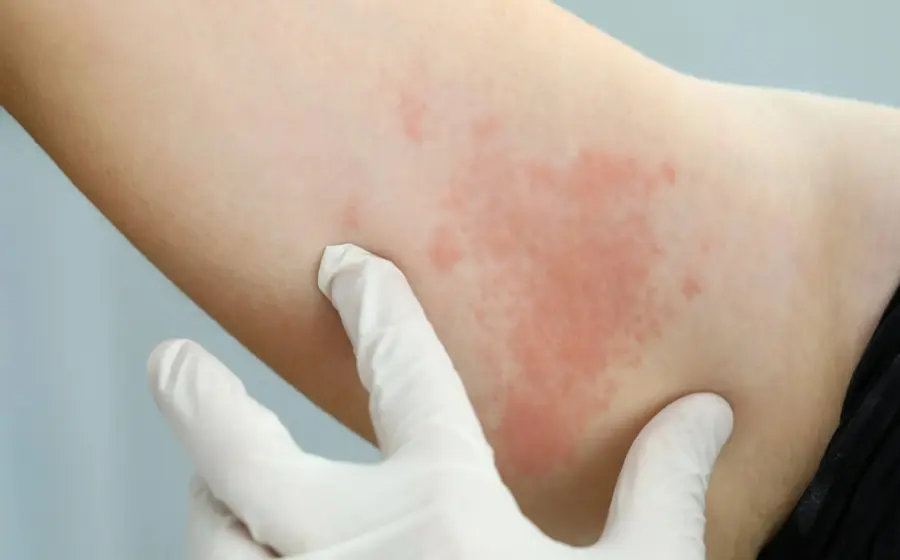 brazo-con-urticaria