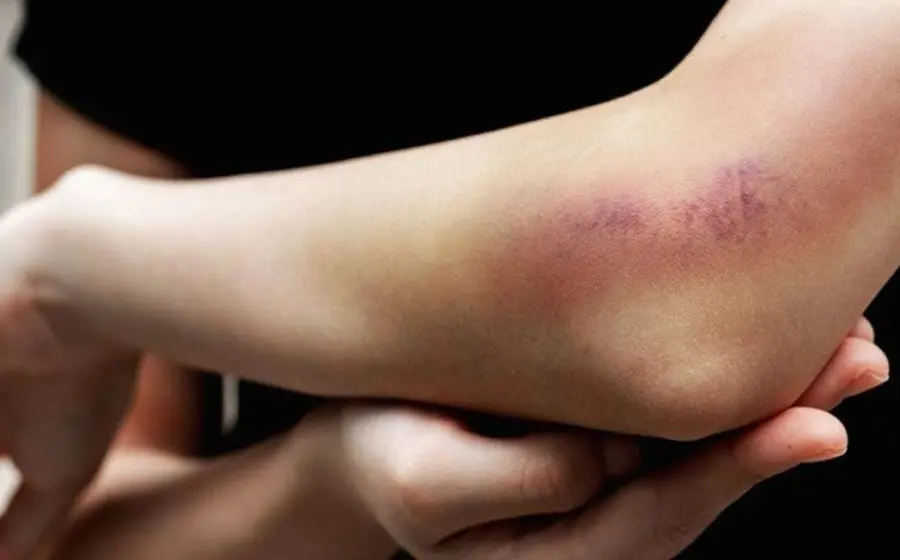 brazo_de_persona