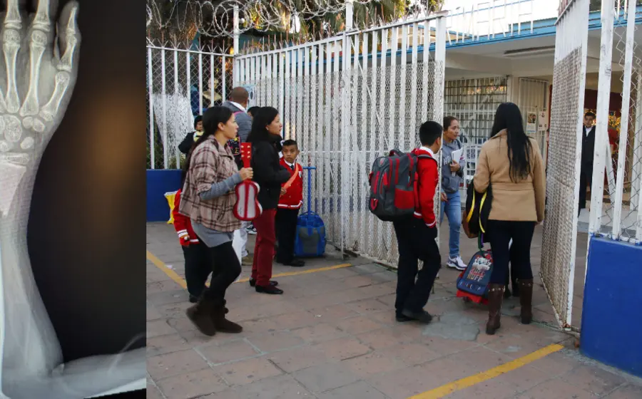 niño-fractura-primaria