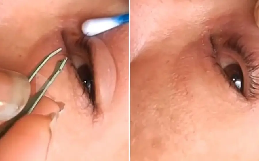 gusano_en_el_ojo