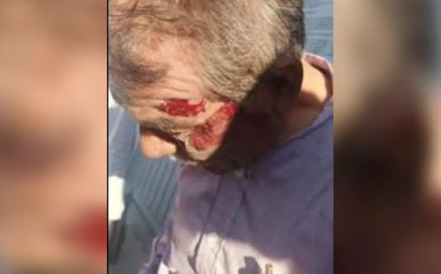 Hombre de 72 años lesionado 