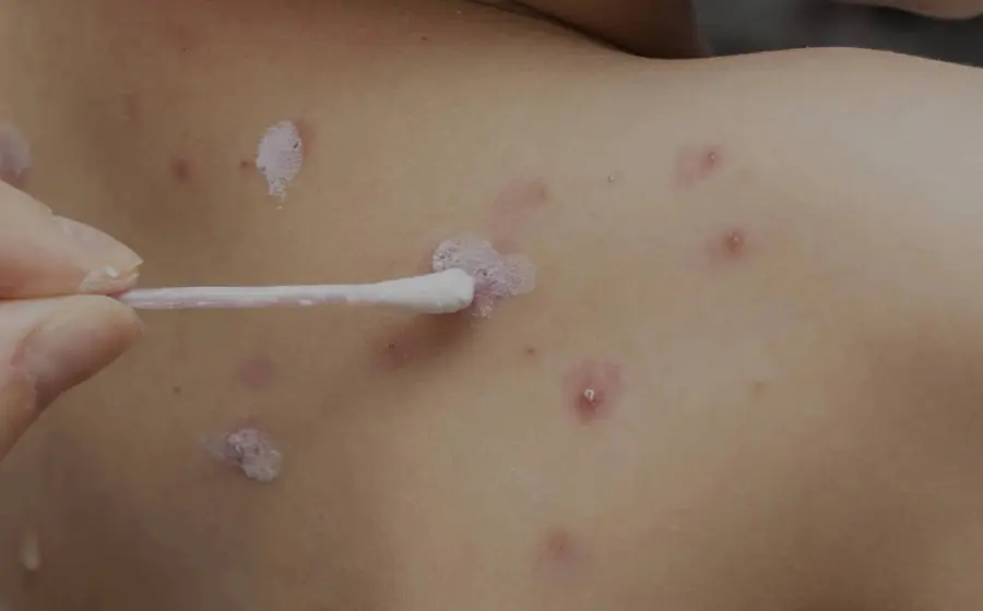 varicela