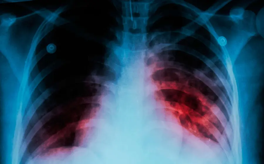 pulmones 