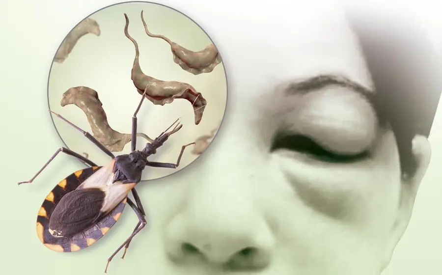 chagas