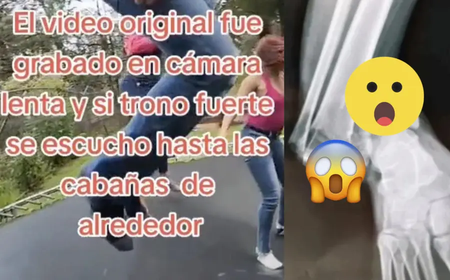 fractura-adriana