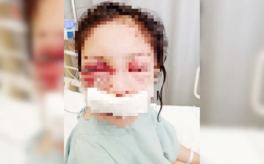 Lía será intervenida quirúrgicamente  una vez que el ojo derecho se haya desinflamado.