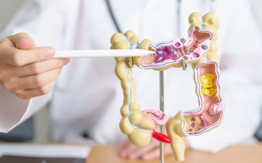 cancer-colon