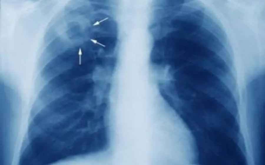 tuberculosis-oaxaca
