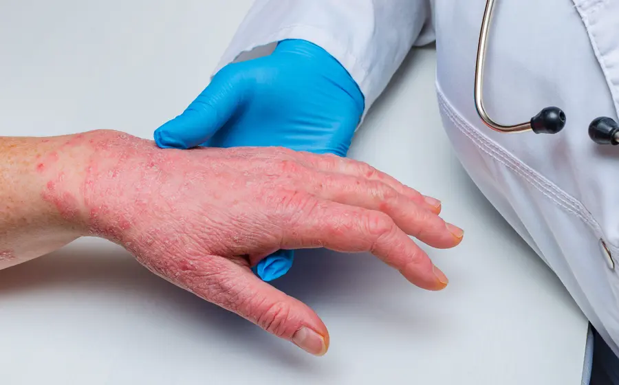 La psoriasis es una enfermedad crónica e incurable, que puede afectar la piel, las uñas y las articulaciones.