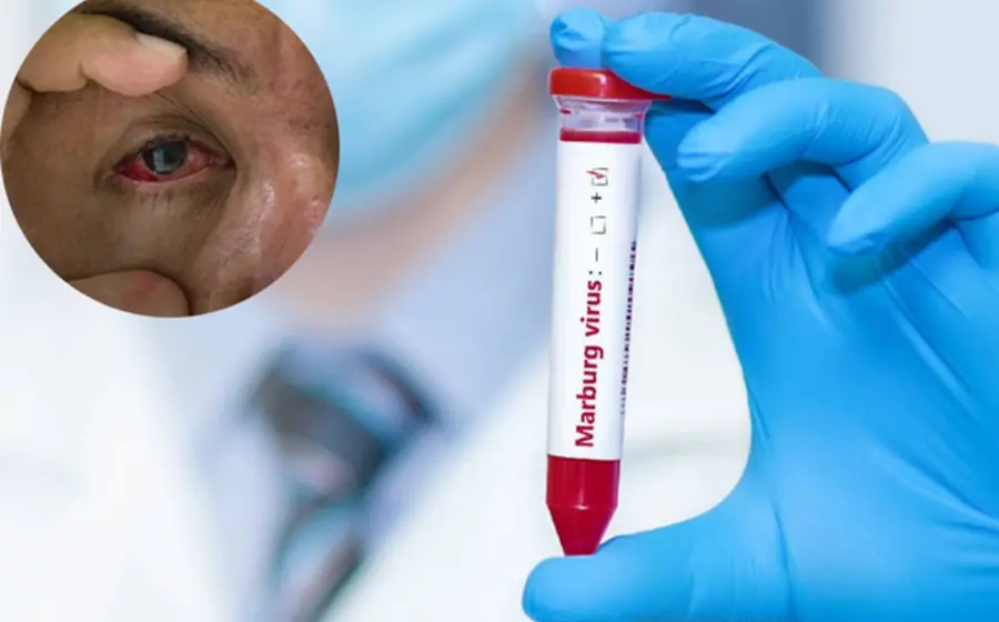 alerta_viaje_virus_marburgo_ruanda
