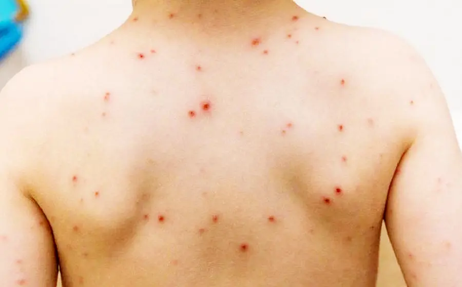mpox