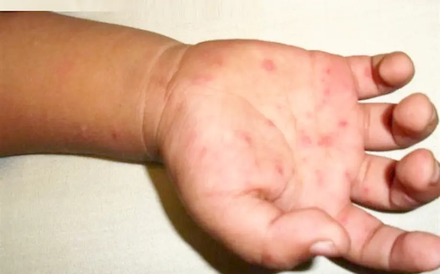 El virus coxsackie causó la enfermedad de manos, pies y boca en cinco menores.