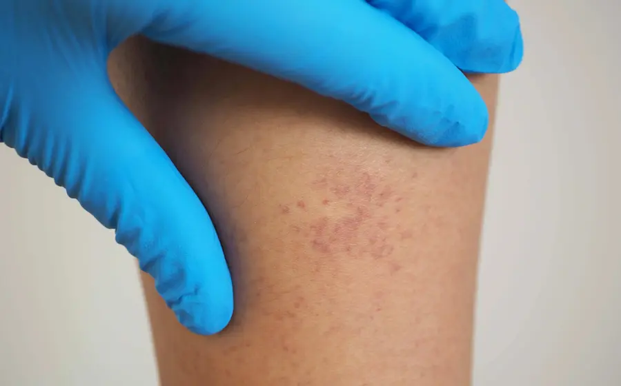 La leucemia es un tipo de cáncer que afecta la sangre y que a veces puede causar manchas rojas en la piel.