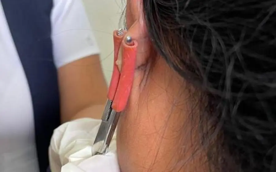 lepra_oaxaca_istmo_salud