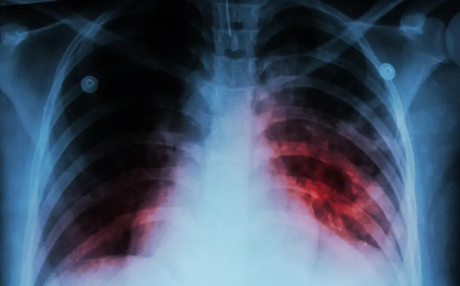 Tuberculosis_share