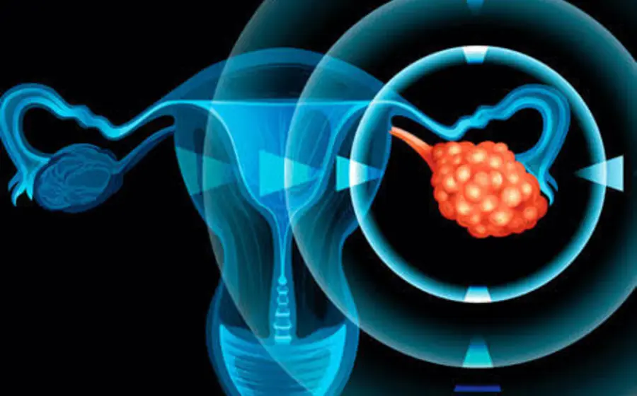 cancer-ovario1