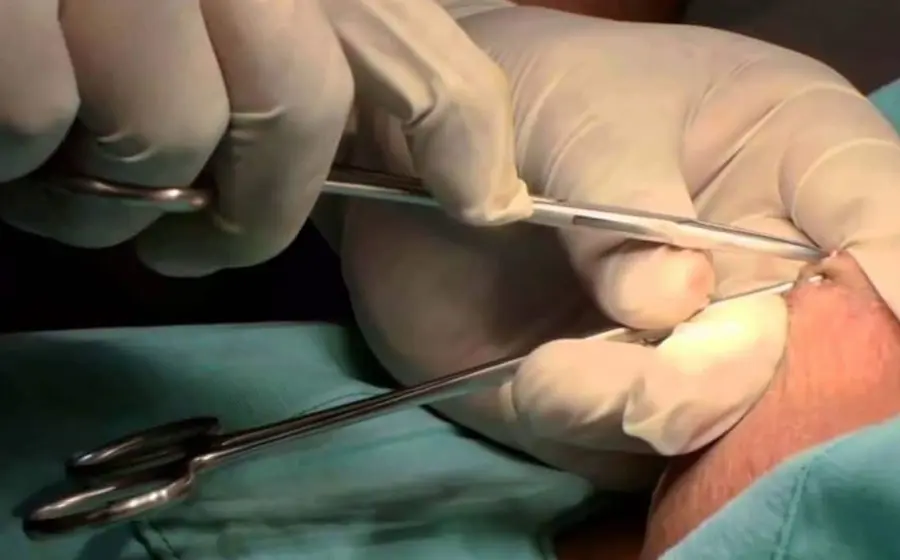 Un médico especialista explica en qué consiste la jornada de vasectomía sin bisturí, un método anticonceptivo permanente, seguro y de rápida recuperación.