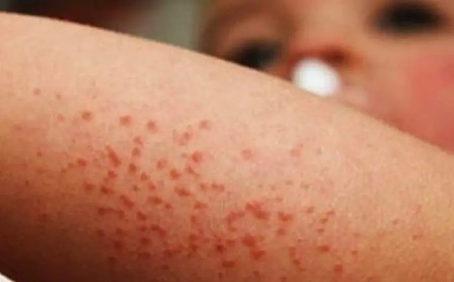 El virus se propaga rápidamente en niños.