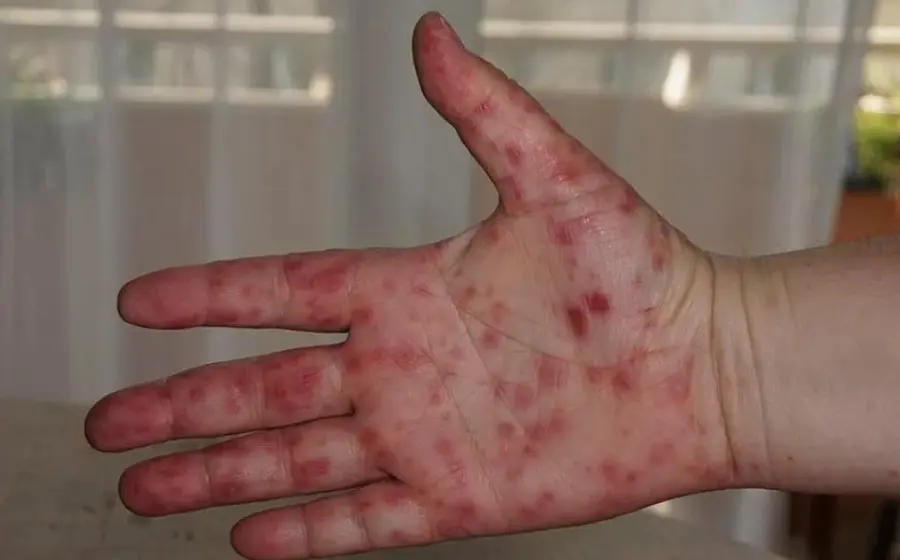 El virus Coxsackie es una infección controlable y no pone en riesgo la vida. Foto: Reporte Índigo