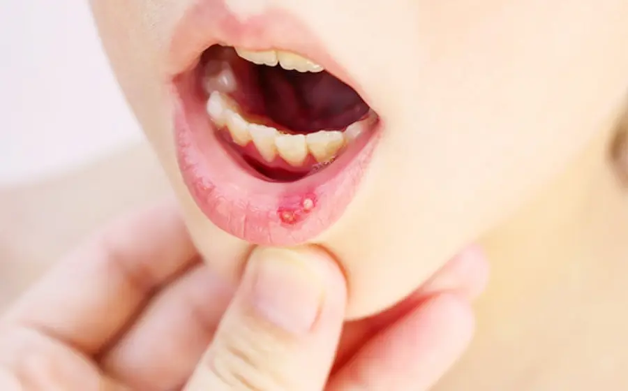 El virus Coxsackie es una infección viral común