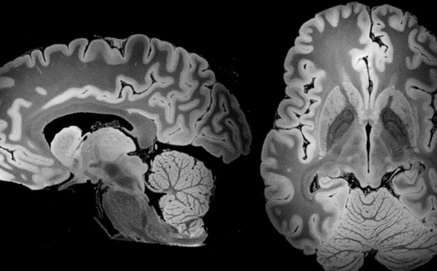 Ilustración conceptual que representa cómo las partículas de plástico logran infiltrarse y contaminar el tejido del cerebro humano sano.
