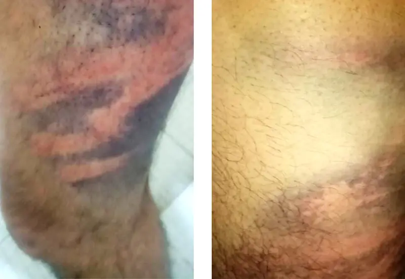 Las lesiones que sufrió Gerson al ser atacado por los elementos de la Policía Municipal de San Jacinto Amilpas.