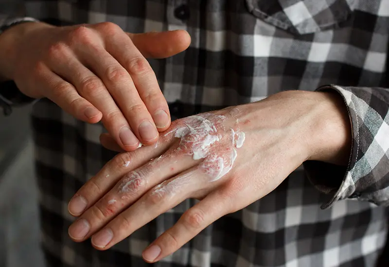 psoriasis