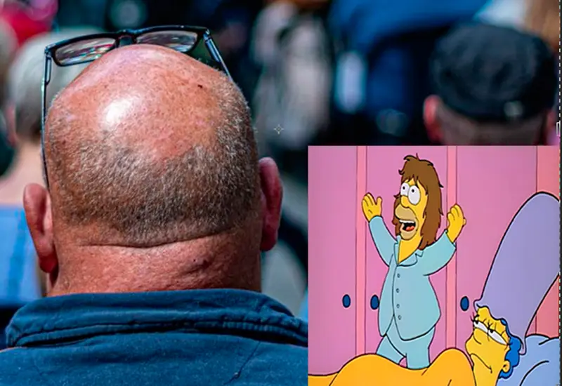 Alopecia