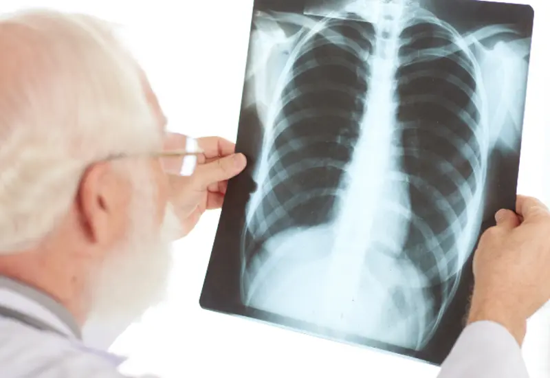 tuberculosis-oaxaca 