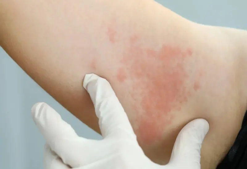 brazo-con-urticaria