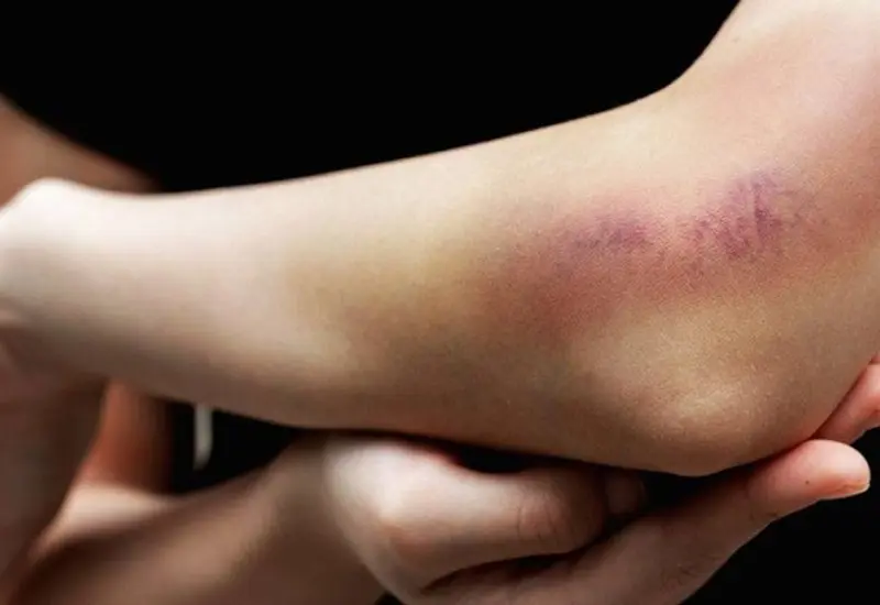 brazo_de_persona