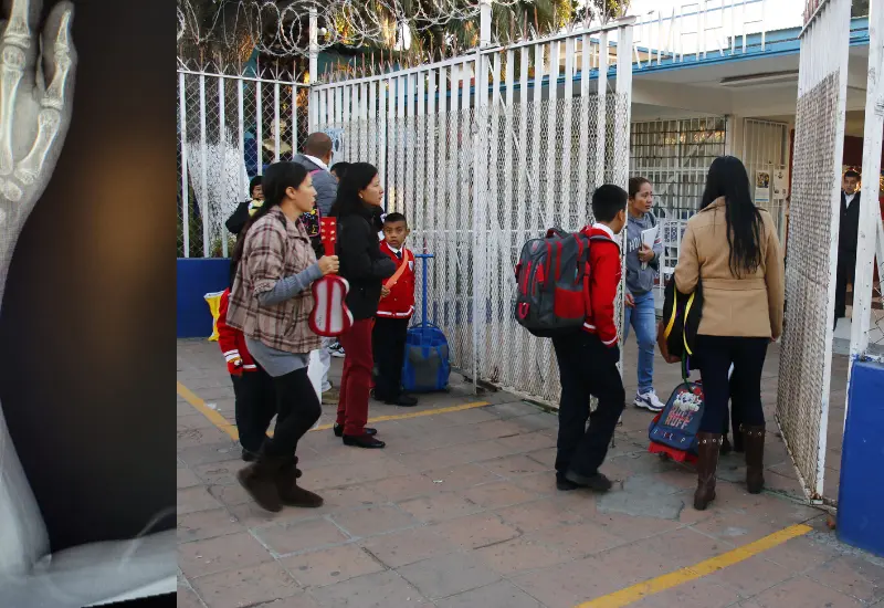 niño-fractura-primaria