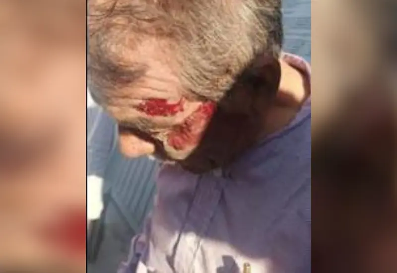 Hombre de 72 años lesionado 