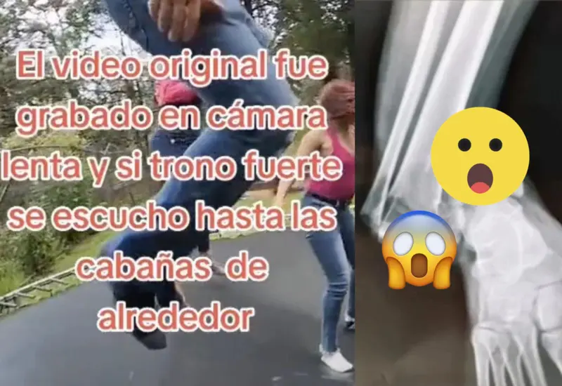 fractura-adriana
