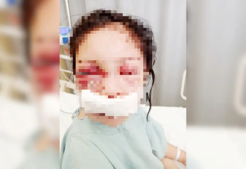 Lía será intervenida quirúrgicamente  una vez que el ojo derecho se haya desinflamado.