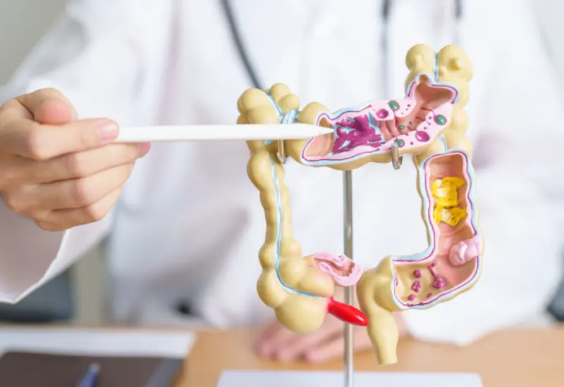 cancer-colon