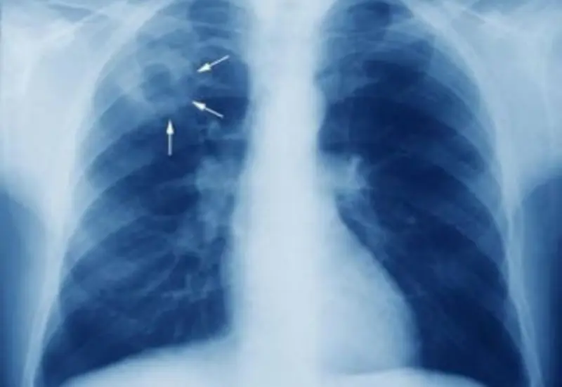 tuberculosis-oaxaca