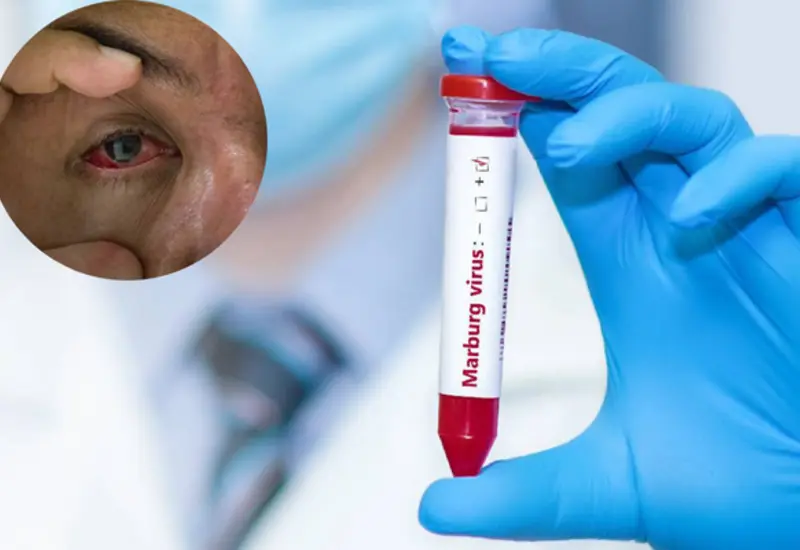 alerta_viaje_virus_marburgo_ruanda