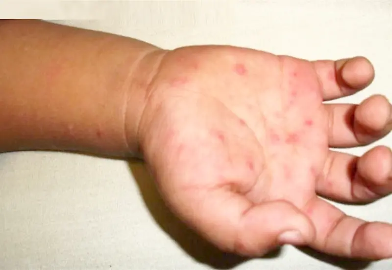 El virus coxsackie causó la enfermedad de manos, pies y boca en cinco menores.