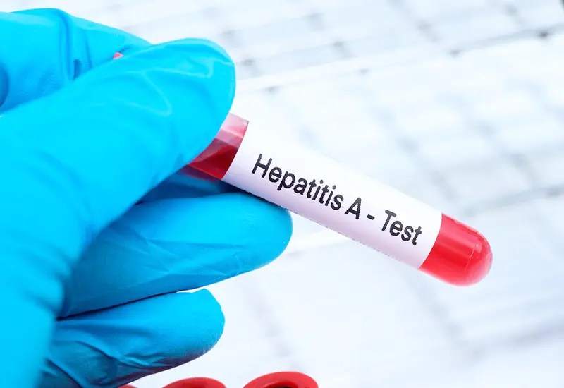 hepatitis
