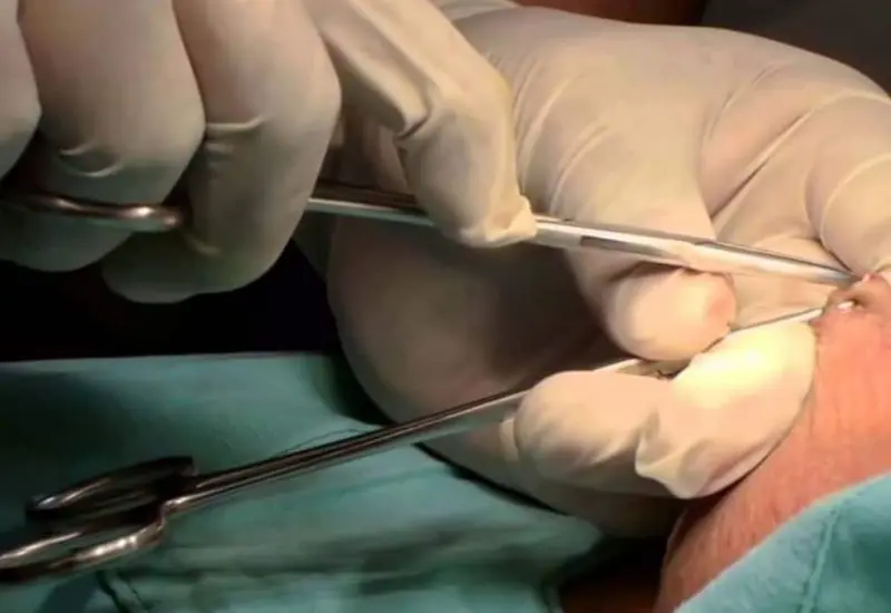 Un médico especialista explica en qué consiste la jornada de vasectomía sin bisturí, un método anticonceptivo permanente, seguro y de rápida recuperación.