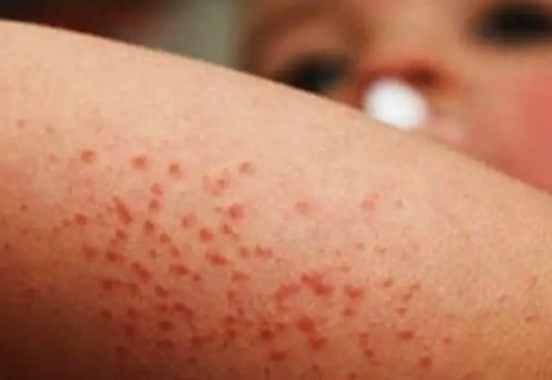El virus se propaga rápidamente en niños.