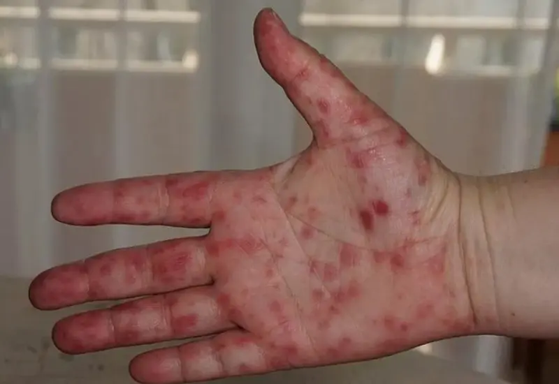El virus Coxsackie es una infección controlable y no pone en riesgo la vida. Foto: Reporte Índigo